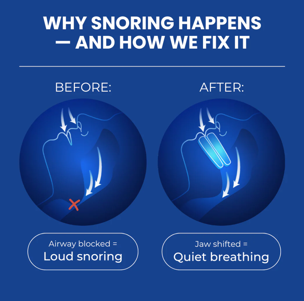 NoSnoreX™ Anti-Snoring Mouthpiece