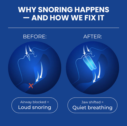 NoSnoreX™ Anti-Snoring Mouthpiece